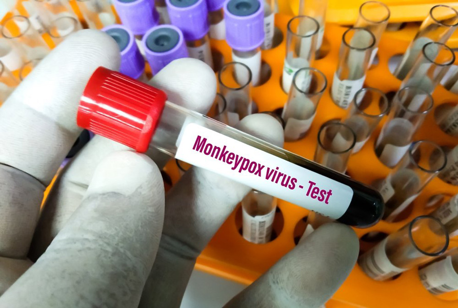 Read more about the article AVERTISMENT: Festivalurile și petrecerile ar putea accelera răspândirea variolei maimuței!